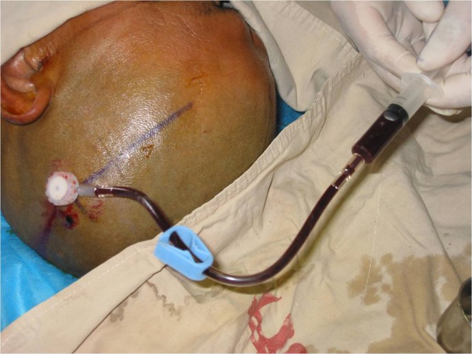 脑出血急救方法,脑出血正确的急救方法