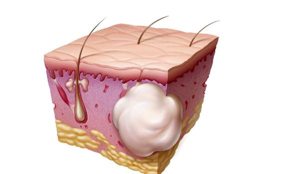 宝宝耳朵后面长了个疙瘩怎么回事,耳朵后面长了个疙瘩是怎么回事