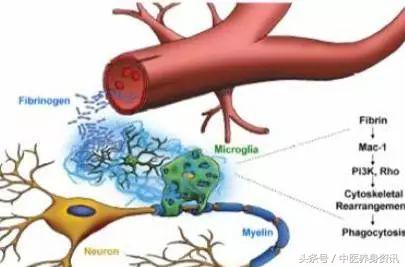 耳鸣脑鸣的真实感受,来自一位中度抑郁症患者内心独白