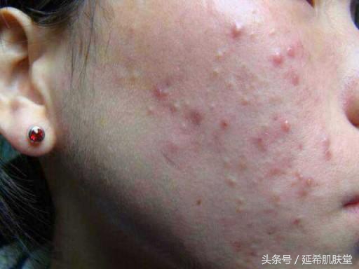 换季长痘是什么原因怎么处理,一到换季就长痘怎么回事