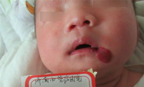 正规治疗婴幼儿血管瘤什么方法好,婴幼儿血管瘤怎么治疗效果好