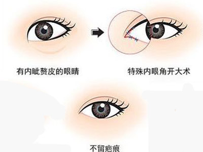 做双眼皮开眼角和不开眼角的区别,想要做双眼皮有什么关注事项吗