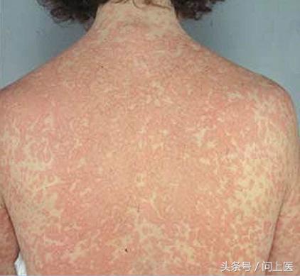 怎样知道青霉素是否过敏,青霉素过敏如何防治