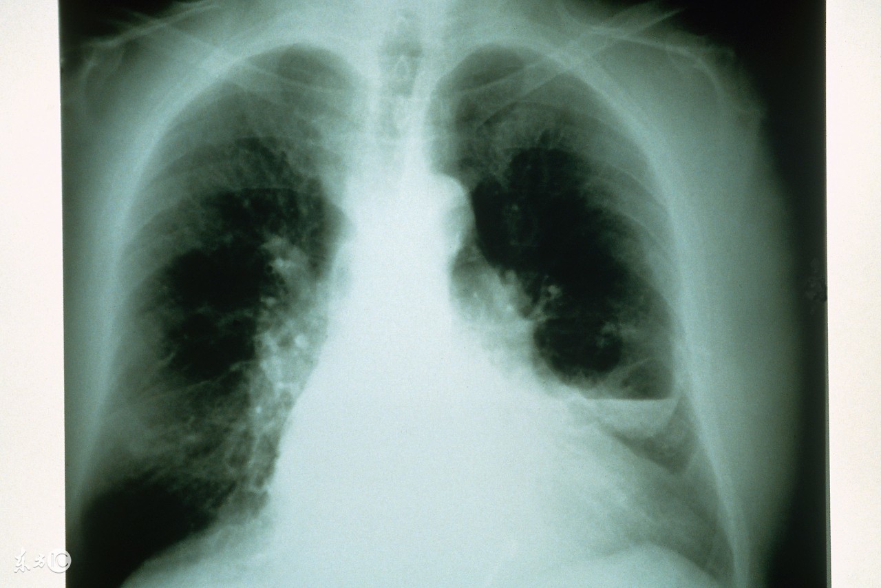 支气管炎怎么食疗调理,气管炎支气管炎最好的食疗方法