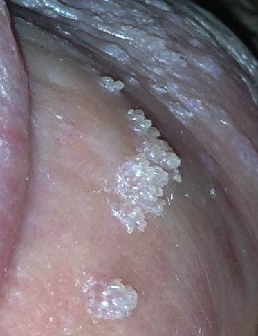 治疗尖锐湿疣要关注这些事情！