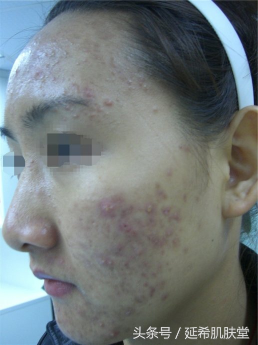 换季长痘是什么原因怎么处理,一到换季就长痘怎么回事