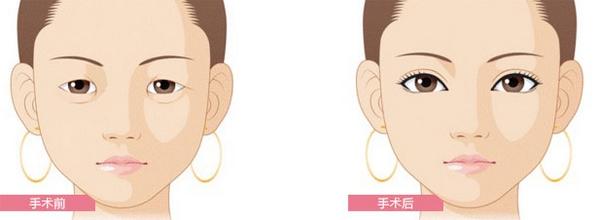 做双眼皮开眼角和不开眼角的区别,想要做双眼皮有什么关注事项吗