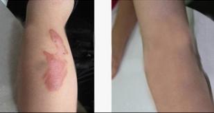 蒸汽把皮肤烫伤后如何预防留疤,水蒸气烫伤起水泡用什么药膏