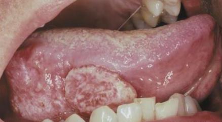 陈忠实为什么会得舌癌,陈忠实的舌癌做了什么治疗