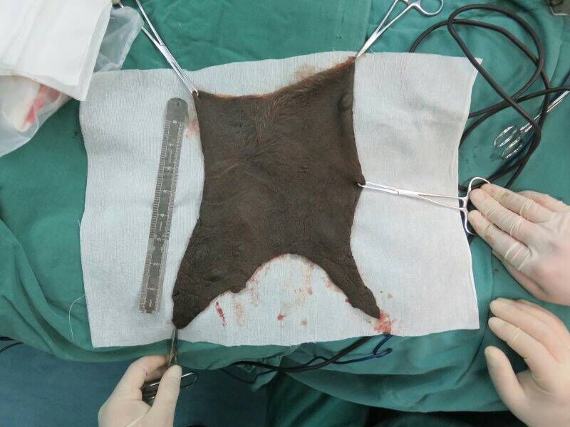 兽皮痣和巨大性黑痣图片,巨大兽皮痣癌变风险