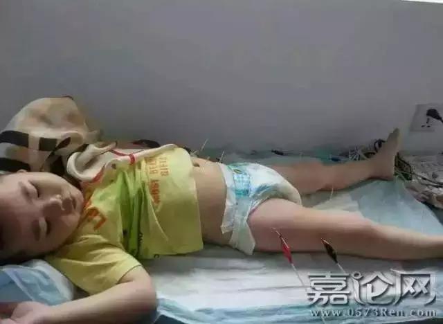 孩子吃了糖丸后遗症,外地儿童在浙江打疫苗吃糖丸