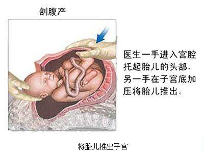 剖腹产麻醉针眼疼痛,剖腹产的时候打的麻醉痛不