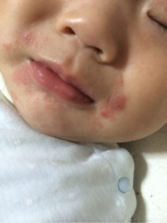 6个月宝宝嘴边眼睛周围有湿疹,6个月的宝宝嘴边起湿疹怎么办