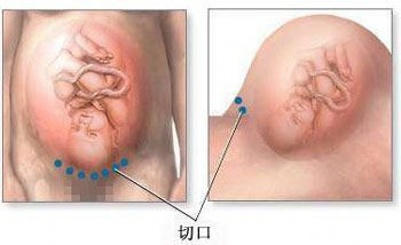剖腹产麻醉针眼疼痛,剖腹产的时候打的麻醉痛不