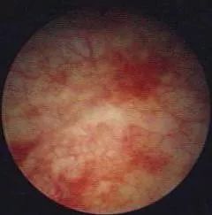 高压氧舱治疗膀胱炎尿血吗,高压氧对慢性肾病有作用吗