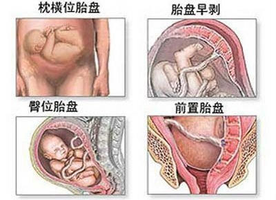 剖腹产麻醉针眼疼痛,剖腹产的时候打的麻醉痛不