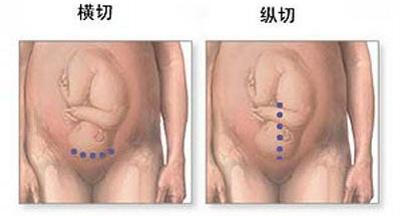 剖腹产麻醉针眼疼痛,剖腹产的时候打的麻醉痛不