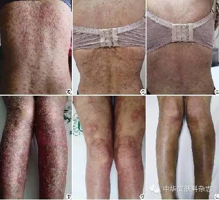 银屑病生物制剂可善挺要打多少针,银屑病生物制剂的效果如何