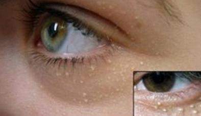 毛孔有脂肪粒什么原因,毛孔里有白色的东西是什么