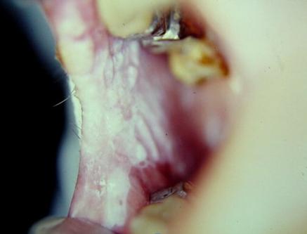 陈忠实为什么会得舌癌,陈忠实的舌癌做了什么治疗