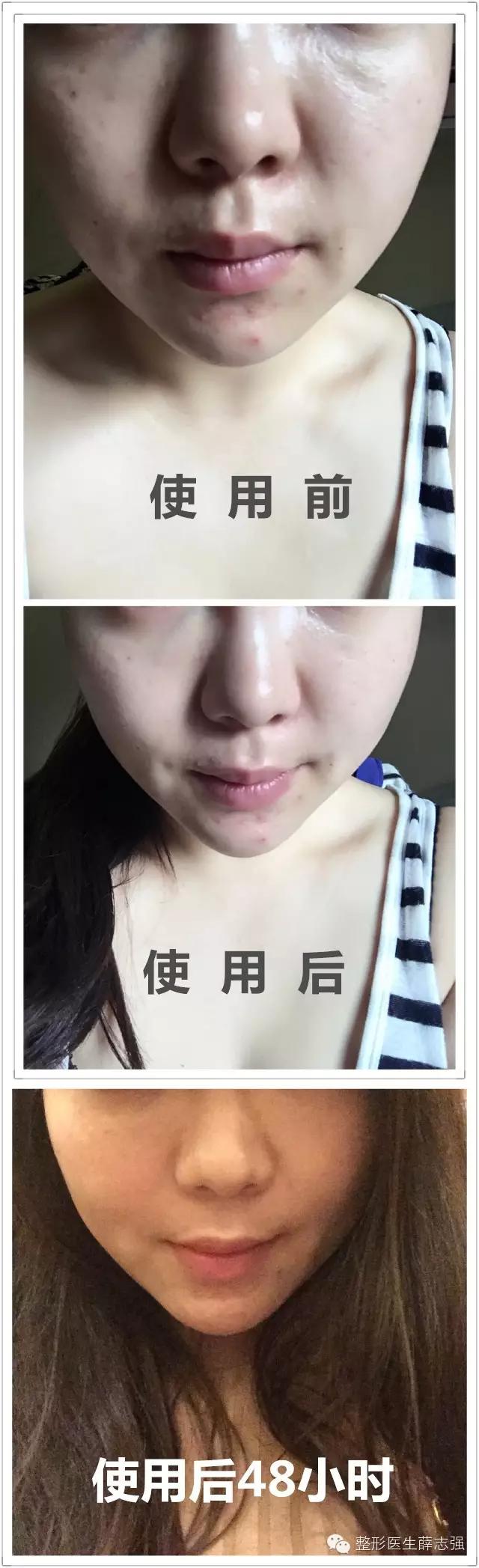 非手术的抗皱紧致怎么做,全脸紧致的方法和原理