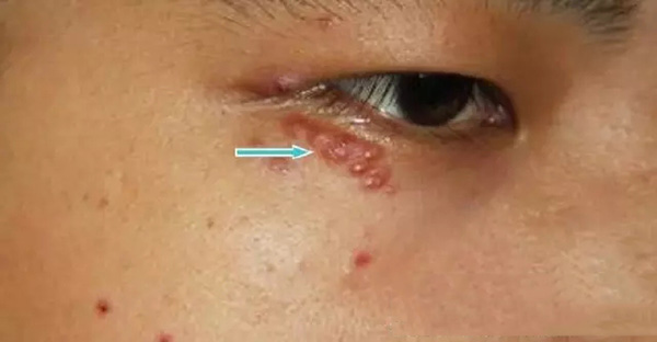 怎样分辨酒渣鼻,酒渣鼻严重怎么治疗