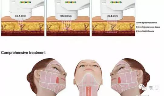 比超声刀更好的治疗方法,膨体隆鼻一年后鼻尖有个痘