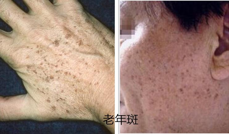 图解一分钟带你认清斑点分类，原来真的每个人都会长斑？
