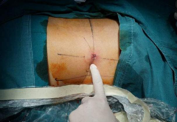 腰椎间盘突出的症状有哪些表现,独活寄生汤治腰椎间盘突出案例