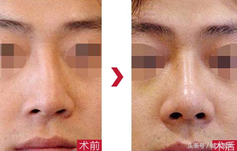 在家如何矫正歪鼻梁,歪鼻梁怎么修容