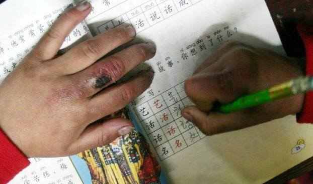 幼儿冻疮的治疗方法,小孩耳朵冻疮的治疗方法