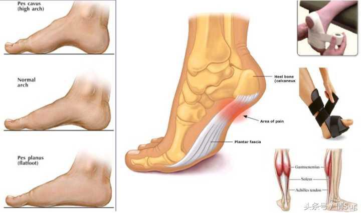 简单几步解决恼人的脚底板酸痛,怎样缓解脚底板的肌肉酸痛