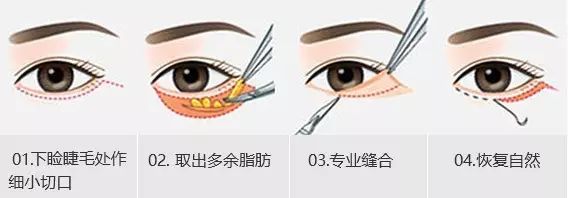 眼袋显老还是泪沟显老,40岁眼袋有泪沟怎么办