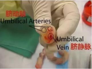 脐带脱垂的真实案例,怎么判断脐带脱垂