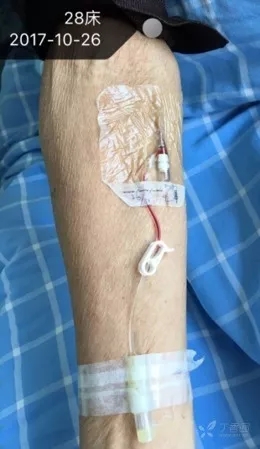 套管针的使用方法和保留方法,怎么让套管针回血