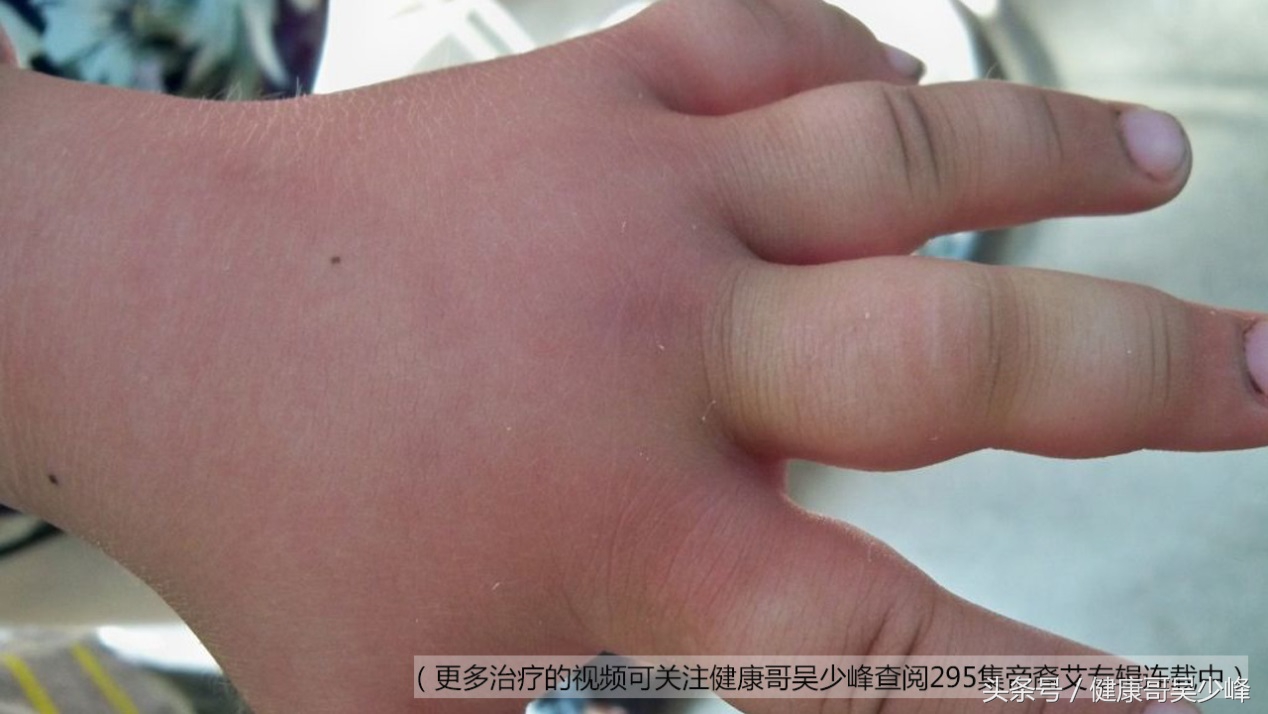 外伤感染发黑怎么处理,外伤导致丹毒