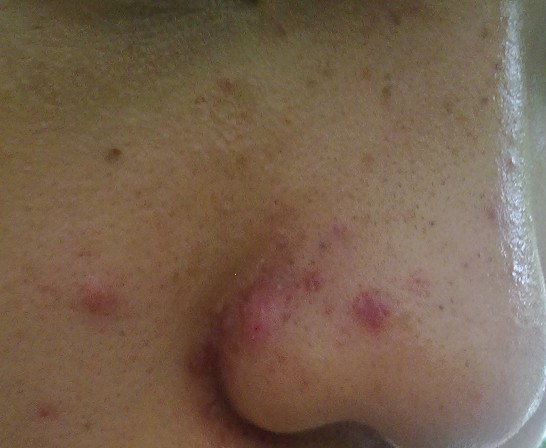 脸部两侧长痘是什么原因怎么办,脸部不同部位长痘是什么原因