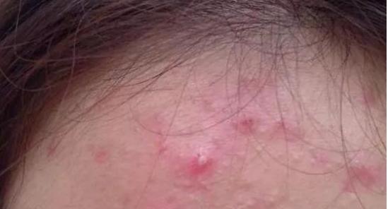 脸部两侧长痘是什么原因怎么办,脸部不同部位长痘是什么原因