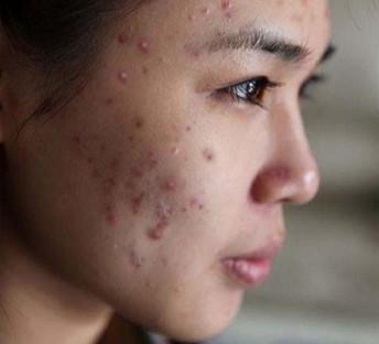 脸部两侧长痘是什么原因怎么办,脸部不同部位长痘是什么原因