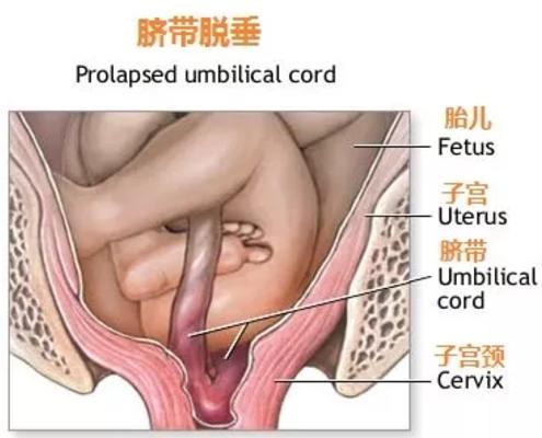 脐带脱垂的真实案例,怎么判断脐带脱垂