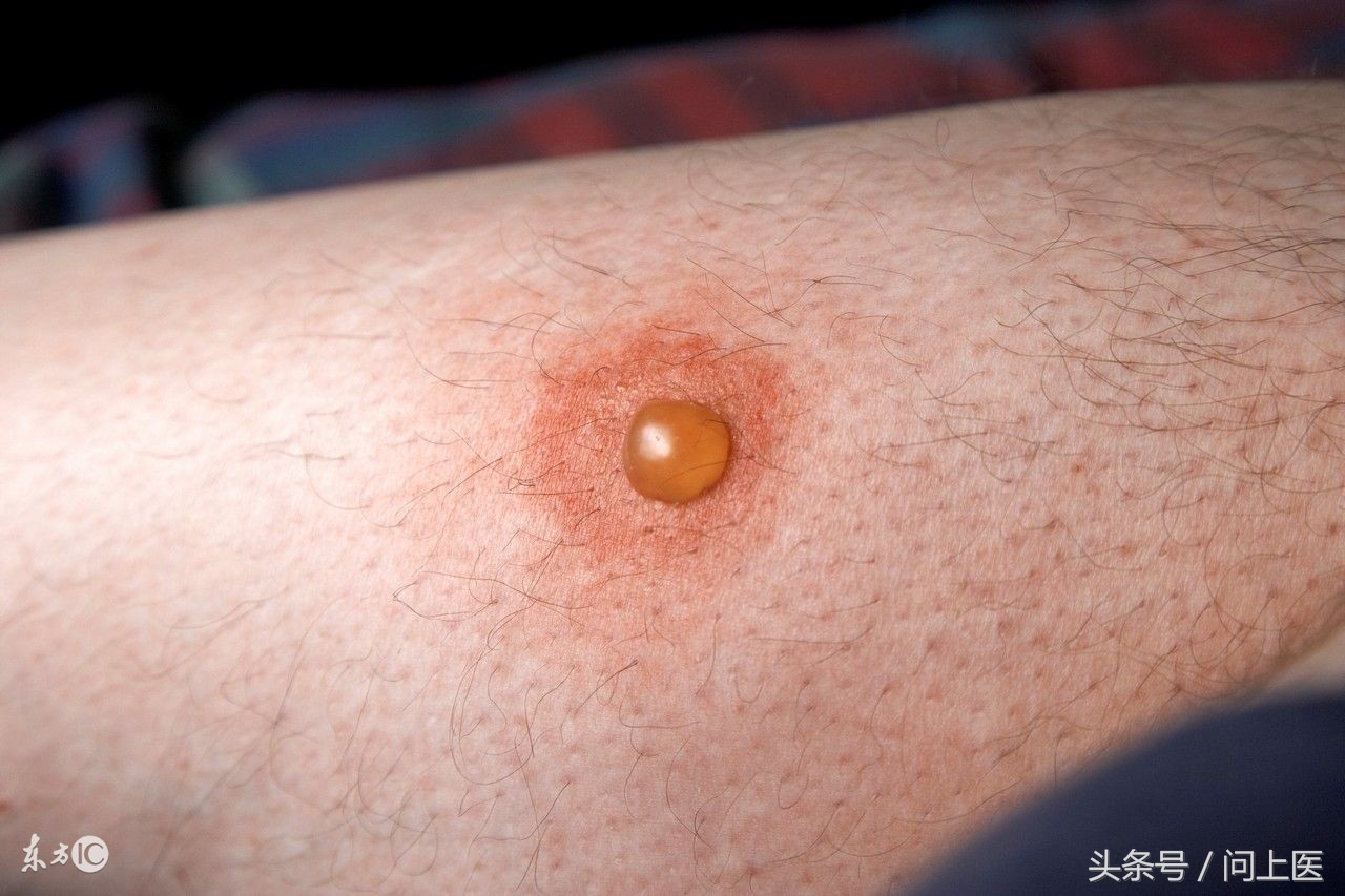 身上起水泡可以戳破吗,身上长的水泡要不要把它弄破