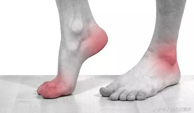 痛风患者的营养治疗关注事项——20180103