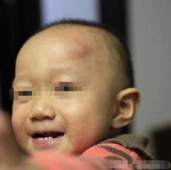 两岁半宝宝头上磕个大包怎么办,两岁宝宝头上磕个包要紧吗