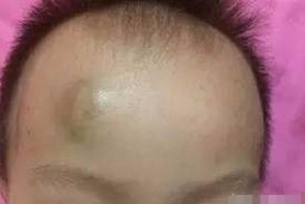 两岁半宝宝头上磕个大包怎么办,两岁宝宝头上磕个包要紧吗