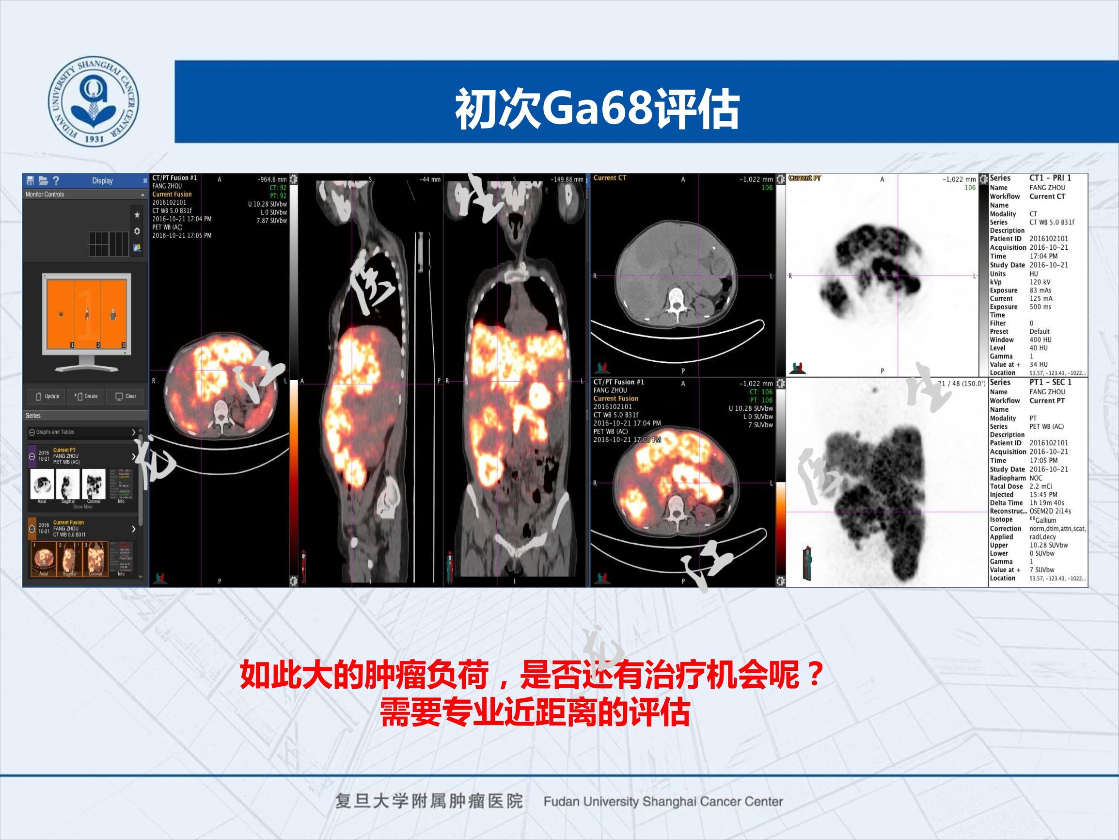 prrt治疗神经内分泌副作用,神经内分泌瘤ssrt