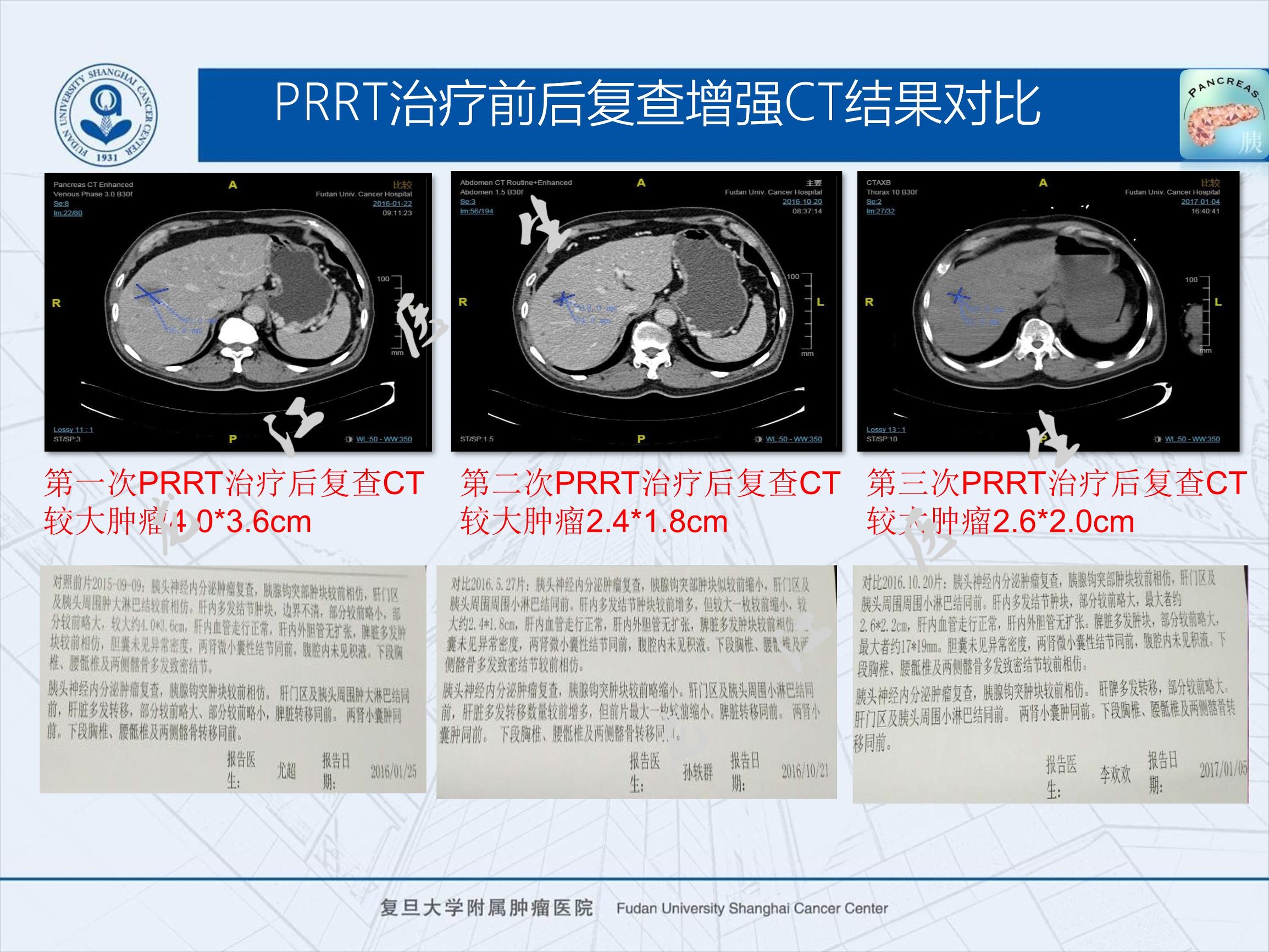 prrt治疗神经内分泌副作用,神经内分泌瘤ssrt