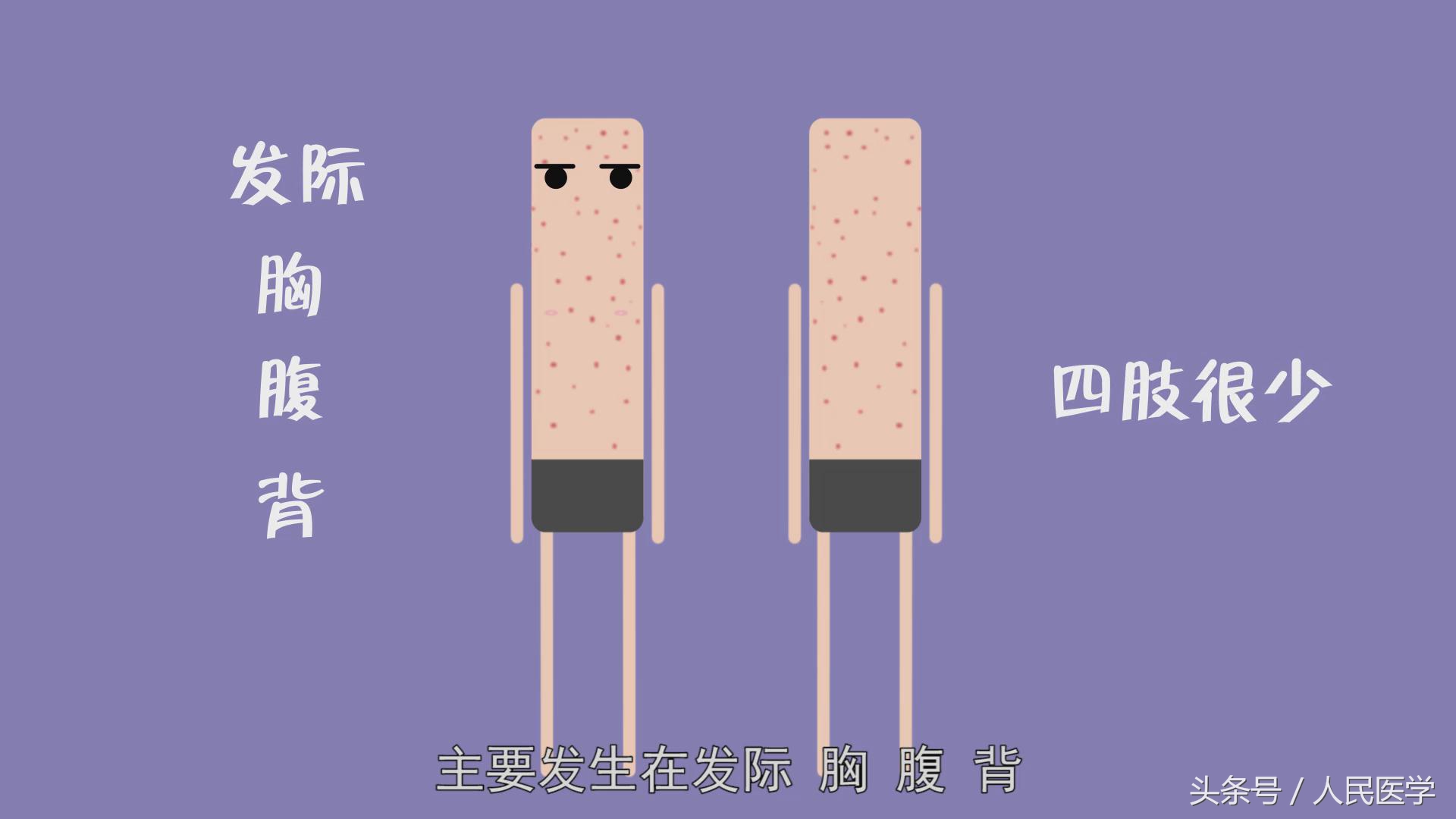 发现学校有孩子得水痘该怎么办,学校出现几例水痘传染病需要停课