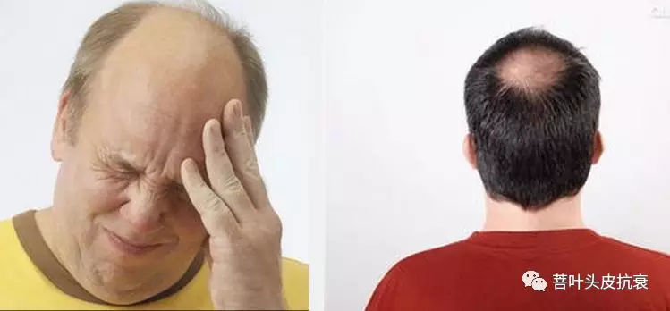 头顶头发稀疏毛囊是否坏死,因为脱发怎么知道毛囊有没有坏死