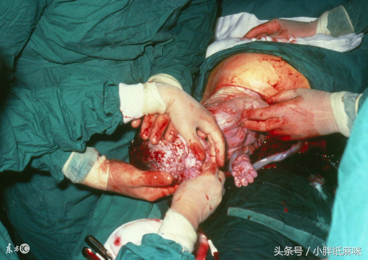 分娩胎儿并发症有哪些,孕妈妈危险