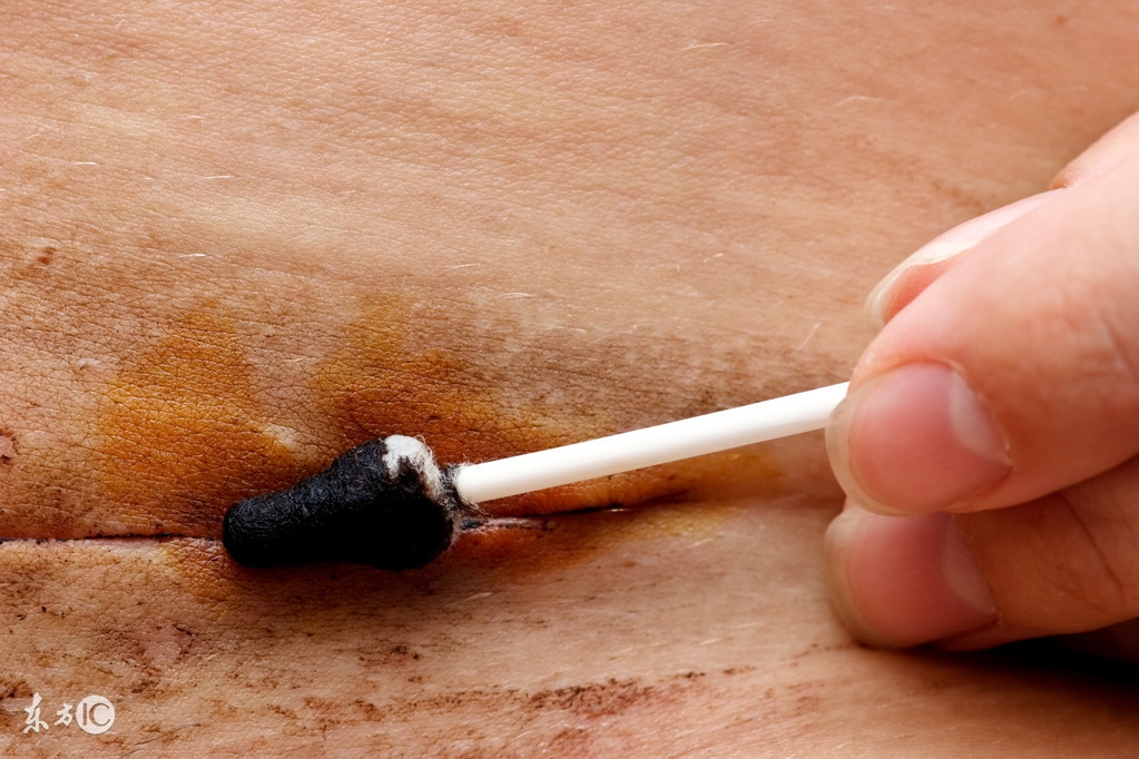 剖腹产12天伤口流血了怎么办,剖腹产24天了突然又流血了